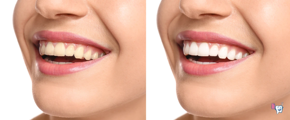 The image shows a a before and after comparison of teeth, with the left mouth showing yellow teeth and the right mouth showing white teeth | For article: How to whiten teeth most effectively | For website: healthychewinggum.com | Source: shutterstock